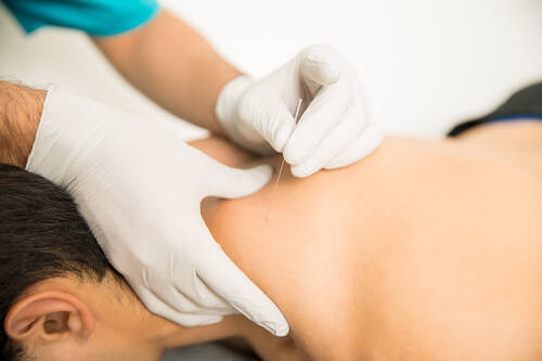Closeup shirtless man receiving dry needling therapy from doctor clinic